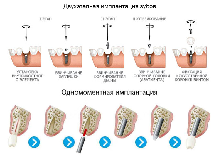Имплантация зубов