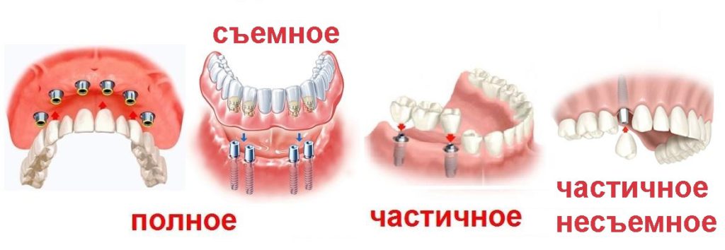 Виды Протезирования Зубов Фото Цены