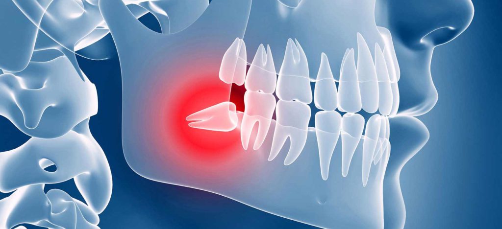 Удаление зуба мудрости