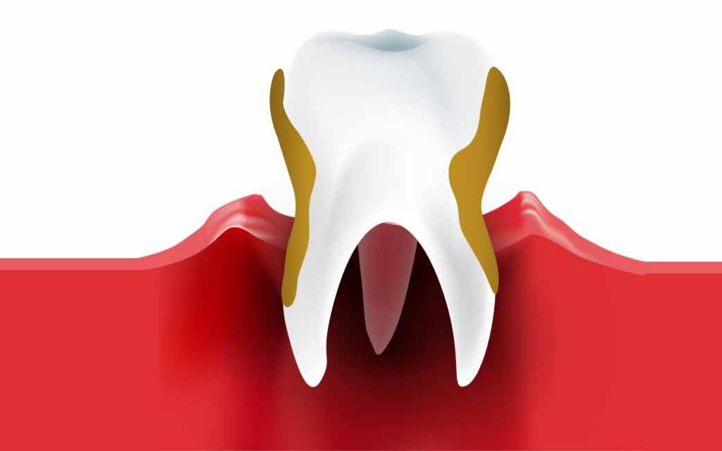 Лечение периодонтита