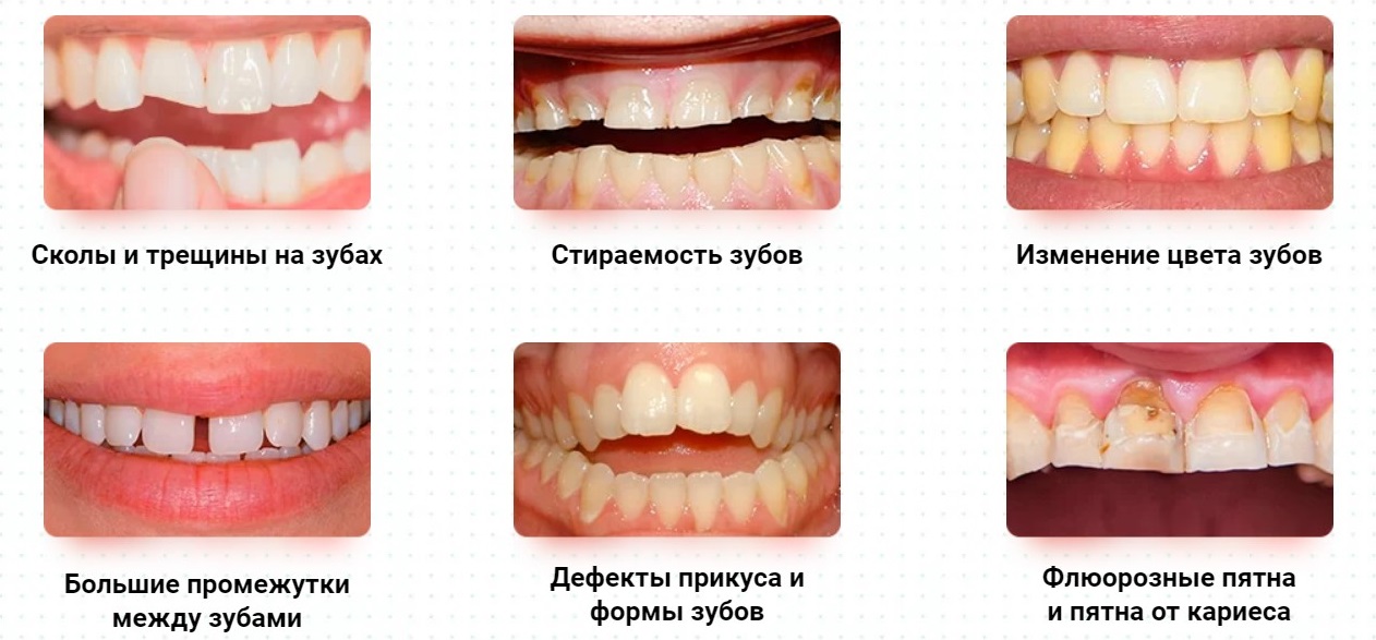Виниры