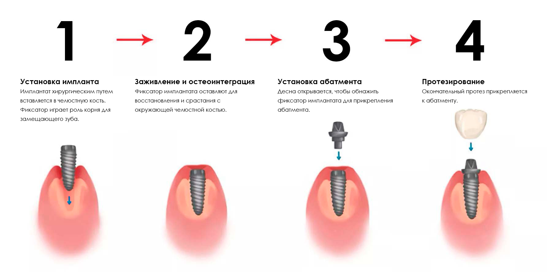 этапы имплантации