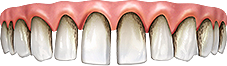 пародонтит зубов