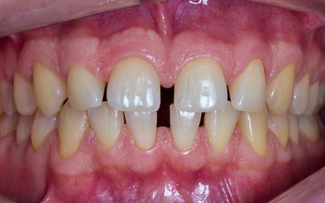 Коррекция зубов и уменьшение диастемы до