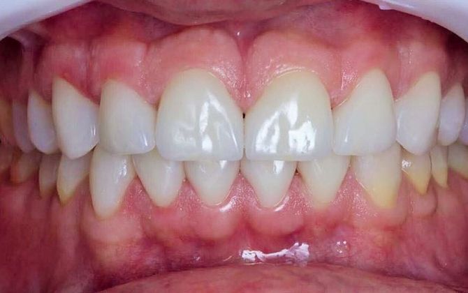 Коррекция зубов и уменьшение диастемы после