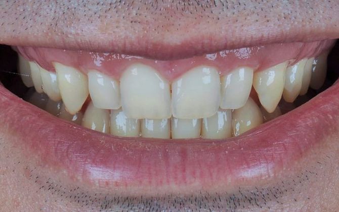 Реставрация зубов до